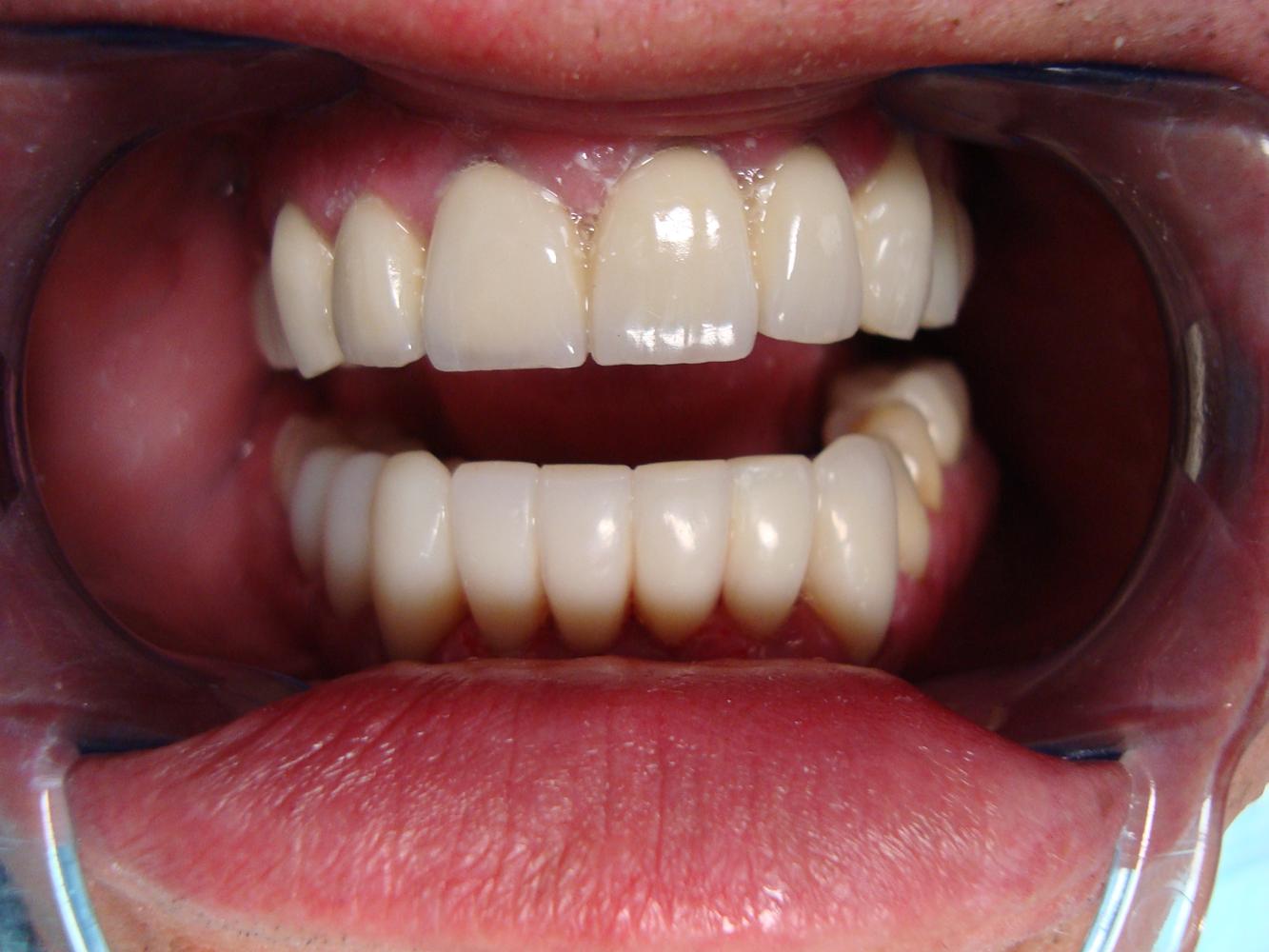 Зубы металлокерамика прикус